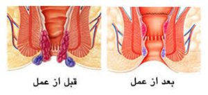 مقایسه درمان هموروئید با دو روش لیزر درمانی و عمل باز | بهترین جراح هموروئید