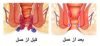خونریزی بواسیر را چگونه می توان کنترل کرد؟ روش های مختلف درمان هموروئید