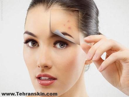 میکرودرم برای جای جوش