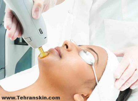 از بین بردن موهای زائد صورت با لیزر در بهترین مرکز لیزر موهای زائد| مرکز لیزر برکه