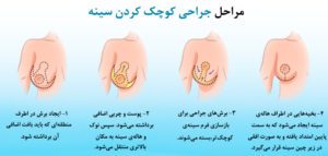 جراحی کوچک کردن سینه همراه با عکس های قبل و بعد | مشاوره و عوارض آن