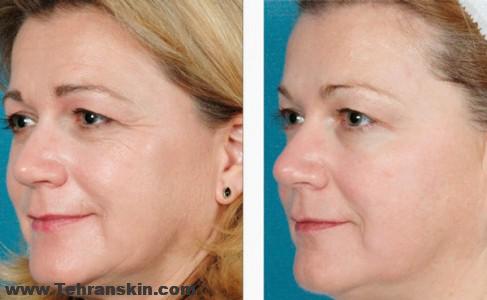 لیفت پلک با آر اف