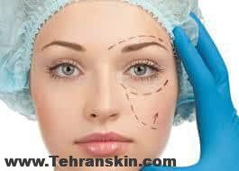 رفع افتادگی پلک با بوتاکس