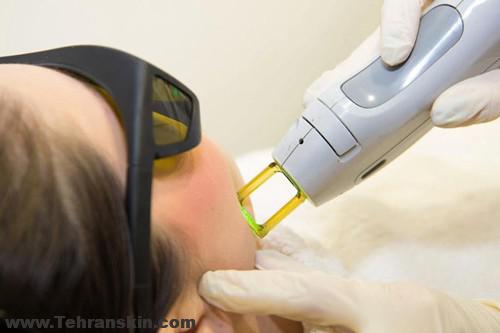 دستگاه لیزر پلاتینیوم چیست