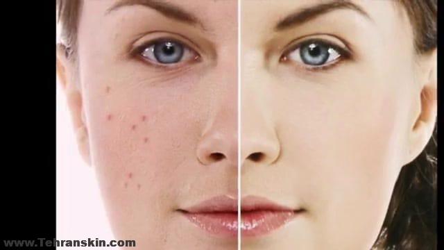 هزینه لیزر جوش صورت