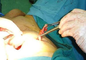 مقایسه درمان هموروئید با دو روش لیزر درمانی و عمل باز | بهترین جراح هموروئید