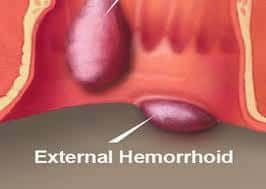 چگونه از هموروئید پیشگیری کنیم؟ | علت هموروئید خارجی چیست؟ | جراحی بواسیر