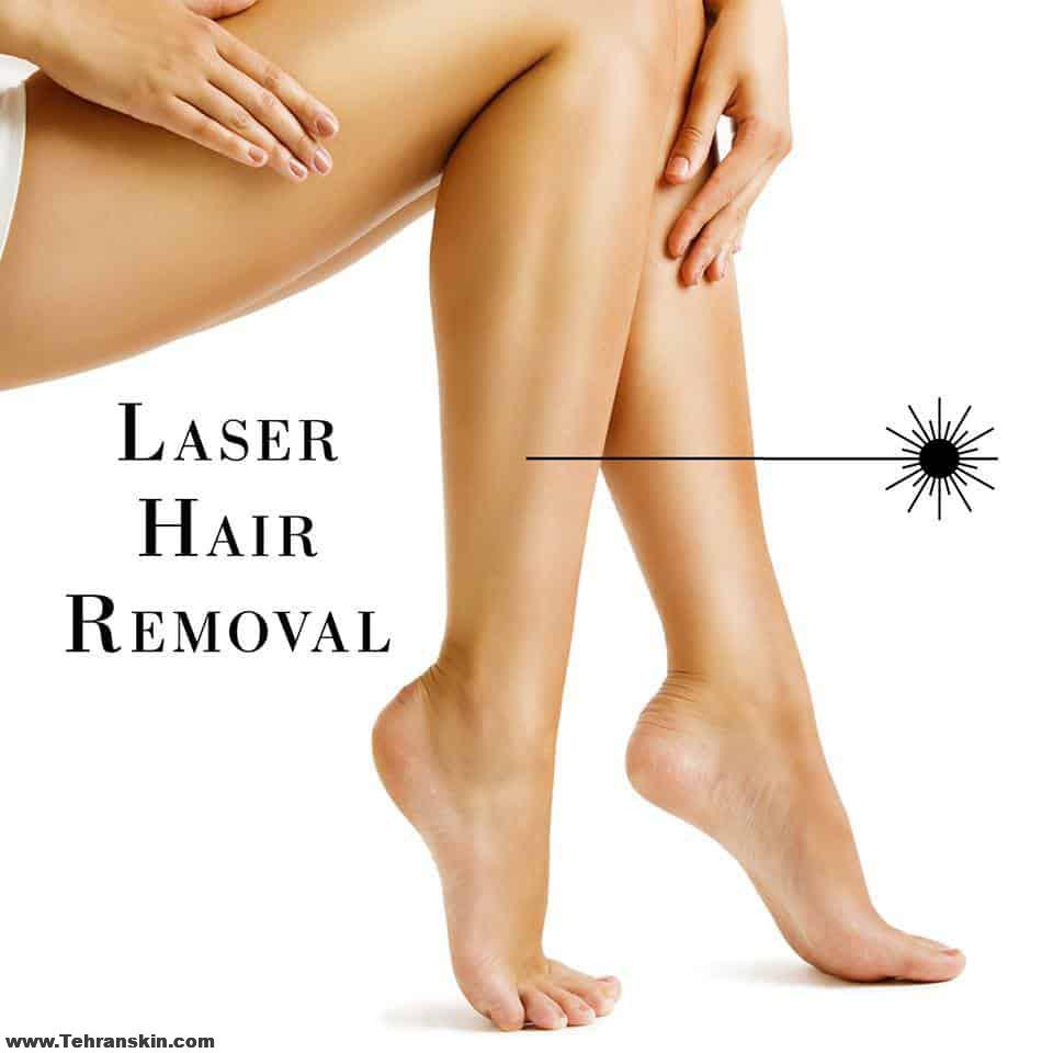 لیزر موهای زائد