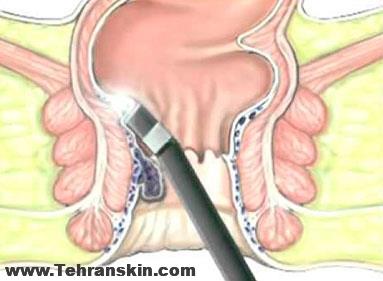 استفاده از لیزر برای درمان هموروئید | درمان بدون درد هموروئید با استفاده از لیزر 