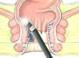 تشخیص و درمان هموروئید | انواع جراحی هموروئید | درمان هموروئید با لیزر