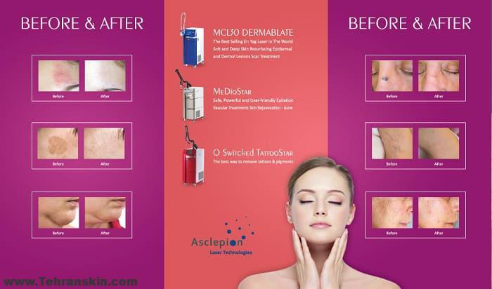 تخفیفان لیزر موهای زائد دستگاه لیزر اسکلپیون مرکز برکه