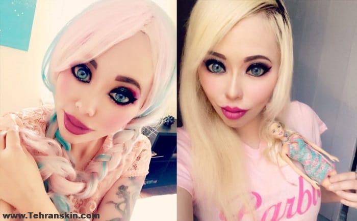 مدل باربی در تزریق ژل لب