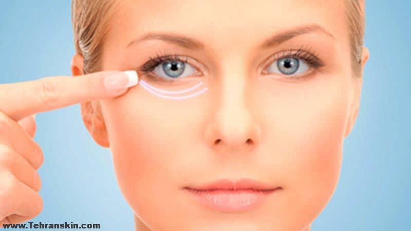 افتادگی پلک پایین