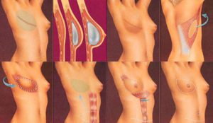 بازسازی پستان پس از سرطان با شیوه های مدرن جراحی ترمیمی