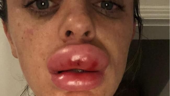 ژل های خطرناک با عوارض جبران ناپذیر