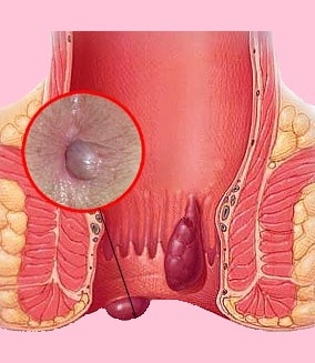 استفاده از لیزر برای درمان هموروئید | درمان بدون درد هموروئید با استفاده از لیزر