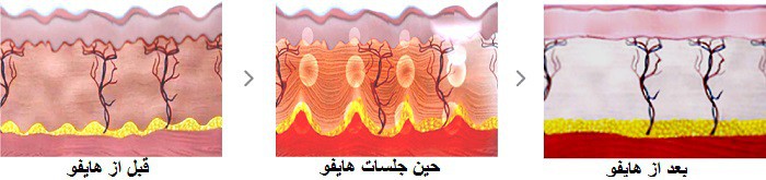 لیفت و سفت سازی پوست با هایفوتراپی