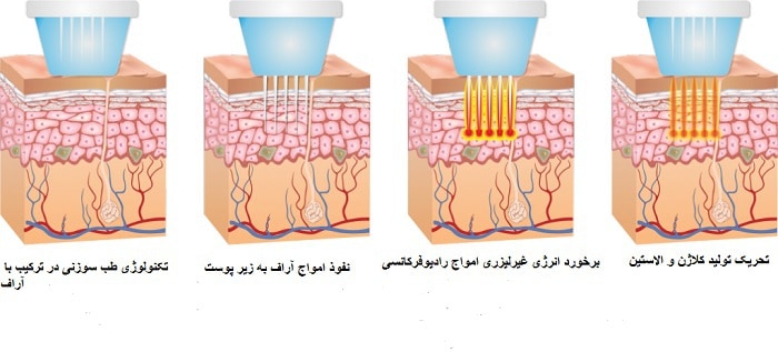 امواج اراف فرکشنال سوزنی چگونه در زیر پوست عمل می کنند؟