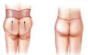 رفع افتادگی و جراحی لیفت باسن | روش جراحی ، مزایا و عوارض و نتایج عمل