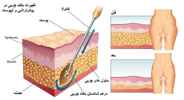 آب کردن چربی اضافه با لیپوست و پیکرتراشی