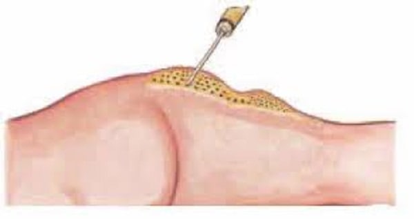 لیپوشیفت و انتقال چربی