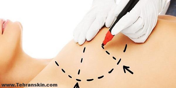 بعد از ماموپلاستی چقدر طول میکشه تا خوب بشم؟ پاسخ پزشکان به این سؤال