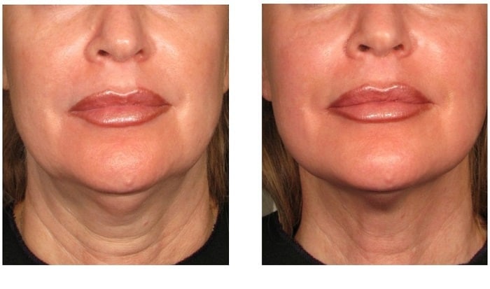 هایفوتراپی گردن در بهترین مرکز تخصصی