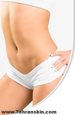 حذف موهای زائد خط بیکینی با لیزر | هزینه لیزر بیکینی چقدر است؟ | مرکز لیزر برکه