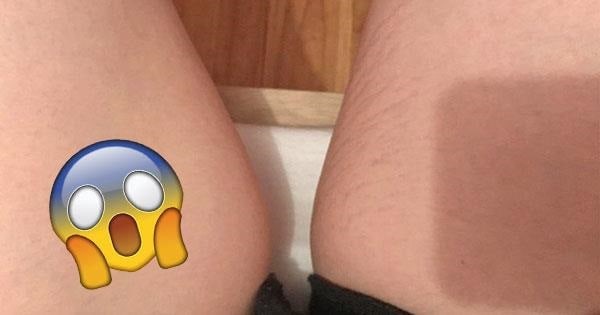 بهترین راه های درمان ترک های پوستی