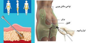  افزایش اندازه باسن با روش های لیفت برزیلی و قرار دادن ایمپلنت | عمل باسن 