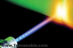 استفاده از لیزر برای درمان هموروئید | درمان بدون درد هموروئید با استفاده از لیزر