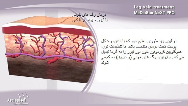 درمان ضایعات عروقی رگی در بینی و پوست با لیزر اسکلپیون