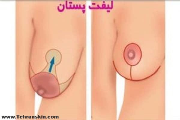روش عمل لیفت سینه چگونه انجام می شود؟ بهترین جراح لیفت سینه