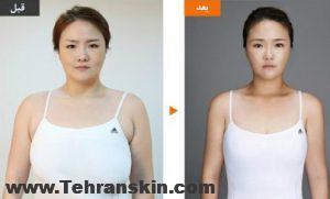 جراحی کوچک کردن سینه همراه با عکس های قبل و بعد | مشاوره و عوارض آن