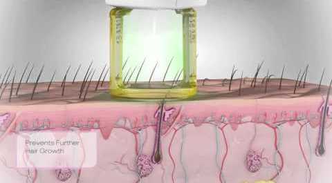 رفع دائمی موهای زائد ناحیه ی تناسلی