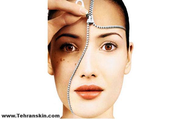 تخفیف میکرودرم