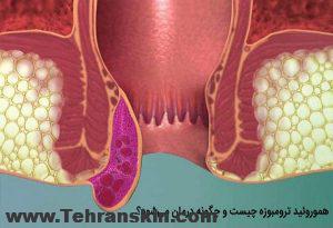 هموروئید ترومبوزه چیست؟ | علائم و درمان | بهترین دکتر هموروئید 
