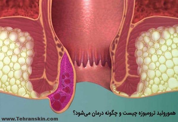 عفونت هموروئید | علل ، علائم ، تشخیص و درمان هموروئیدی که عفونت کرده