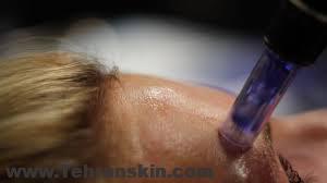 میکرونیدلینگ چروک