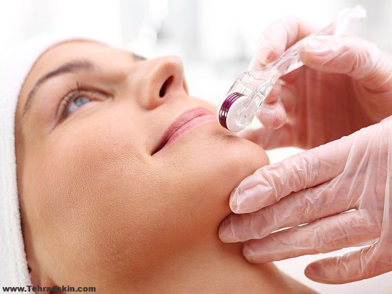 قرمزی بعد از میکرونیدلینگ