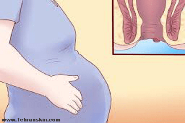 علت ابتلا به بواسیر در دوران بارداری و پیشگیری| جراحی هموروئید در دوران حاملگی