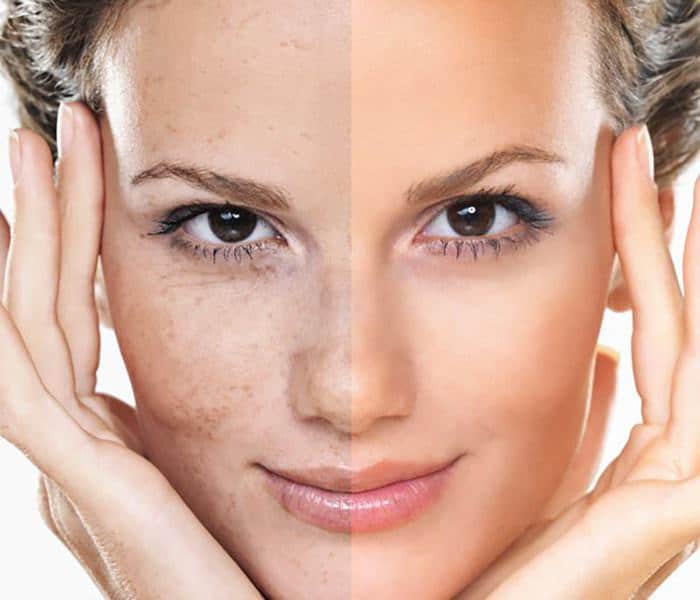 بهترین و موثرترین روش جوانسازی پوست چیست
