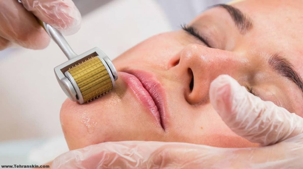 ماندگاری میکرونیدلینگ