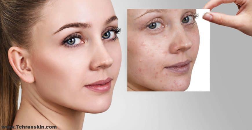 آیا میکرودرم برای جای جوش خوبه ؟