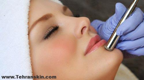 پاکسازی پوست با دستگاه میکرودرم ابریژن