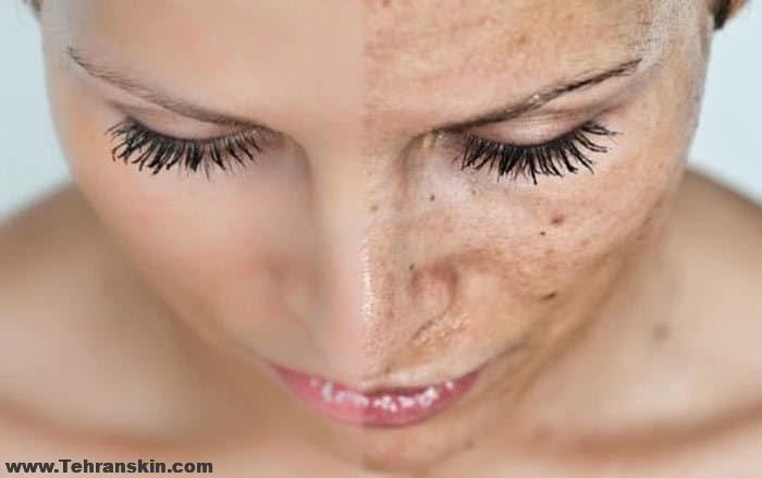 میکرونیدلینگ عمیق