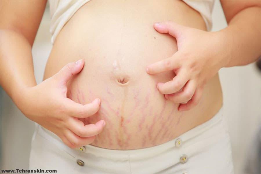 درمان ترک های پوستی