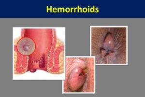 عفونت هموروئید | علل ، علائم ، تشخیص و درمان هموروئیدی که عفونت کرده 