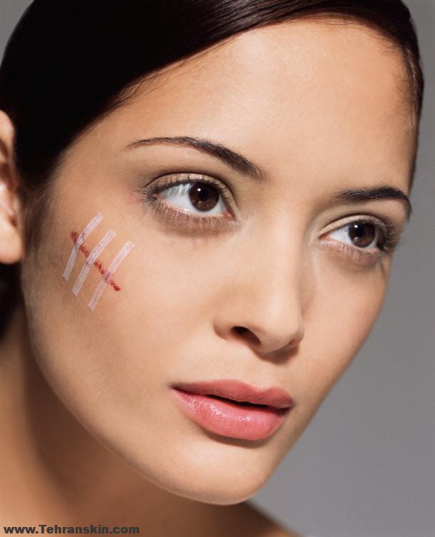 از بین بردن جای اسکار زخم