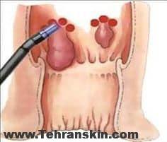 چطوری درد بعد از عمل هموروئید را تحمل کنیم؟ | عمل بدون درد بواسیر با لیزر